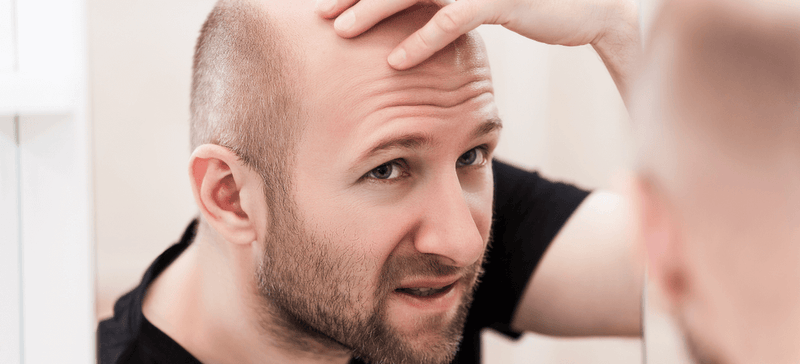 Hair loss in men: what can be done?